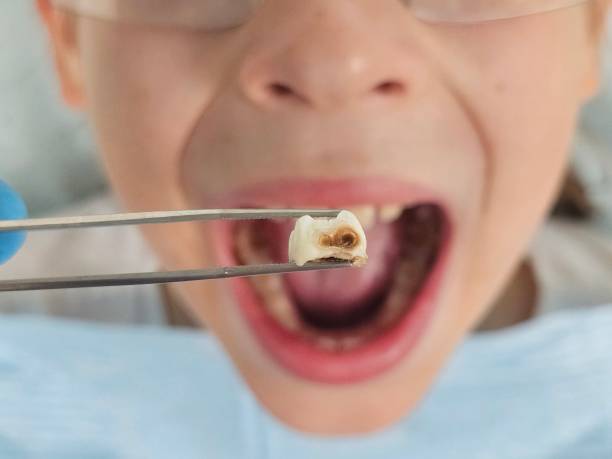 Best Emergency Dental Care for Abscessed Tooth in Warren, PA